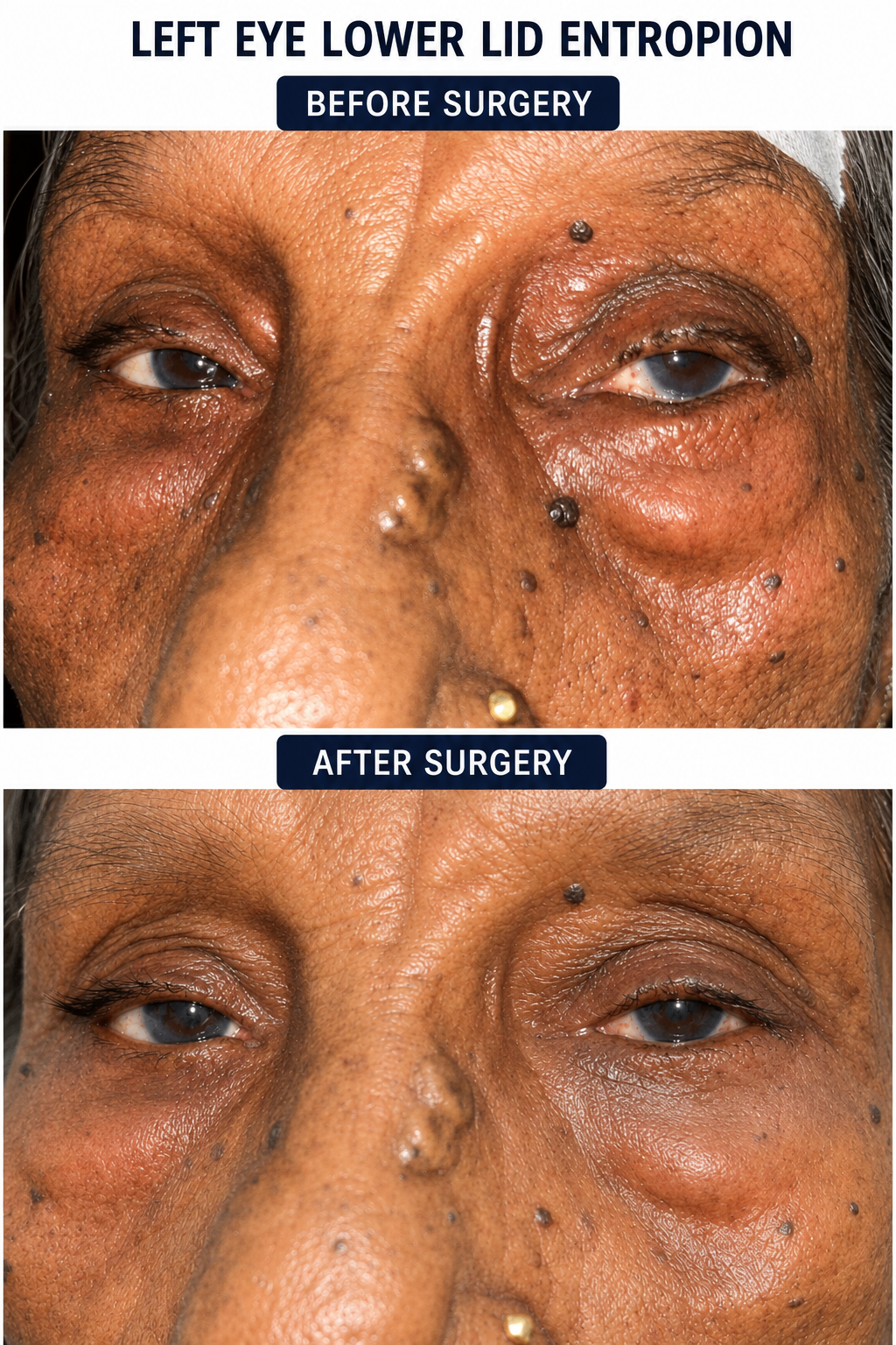 Entropion surgery at Shantanu Netralaya under Ayushman Bharat scheme