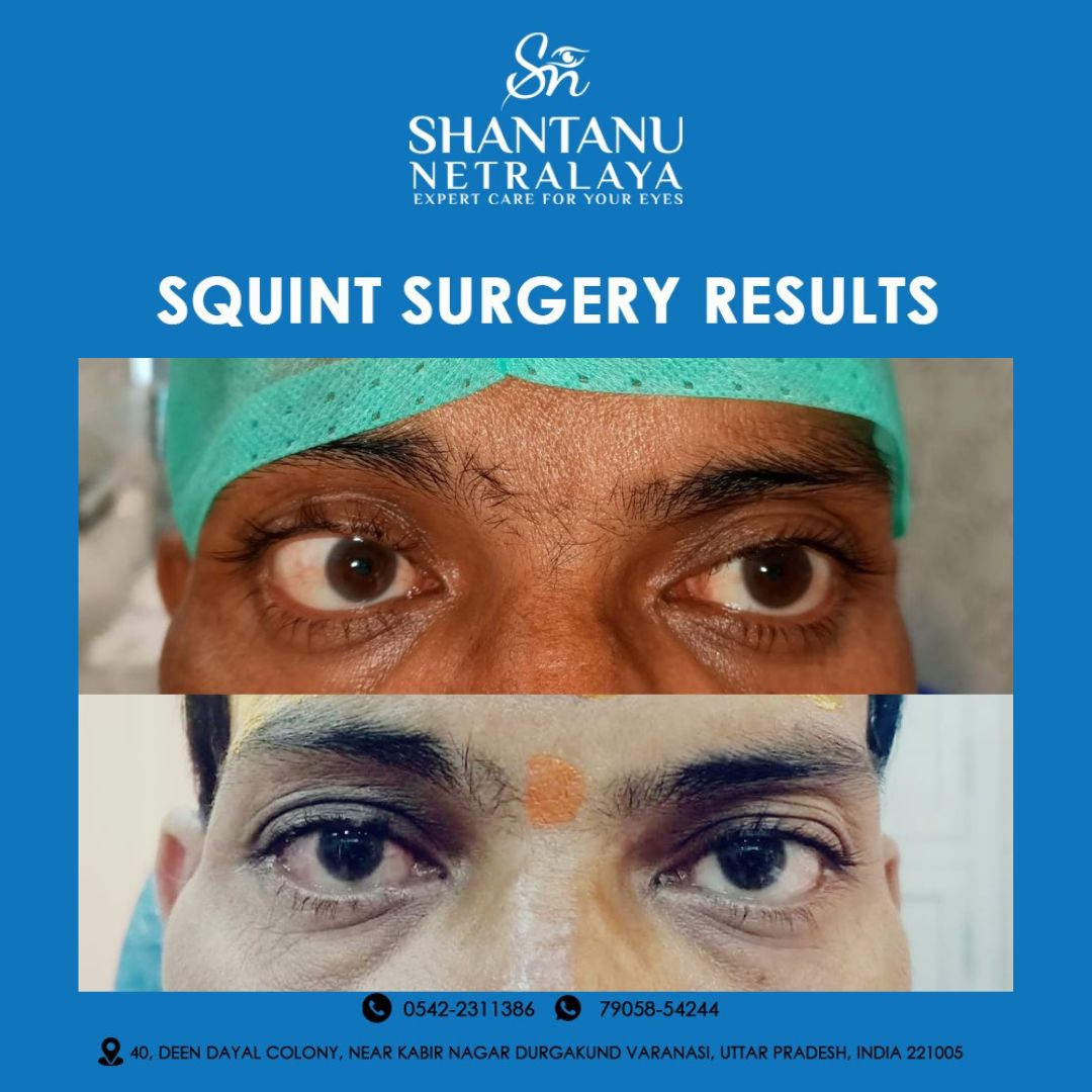Long standing 6th nerve palsy successfully treated surgically