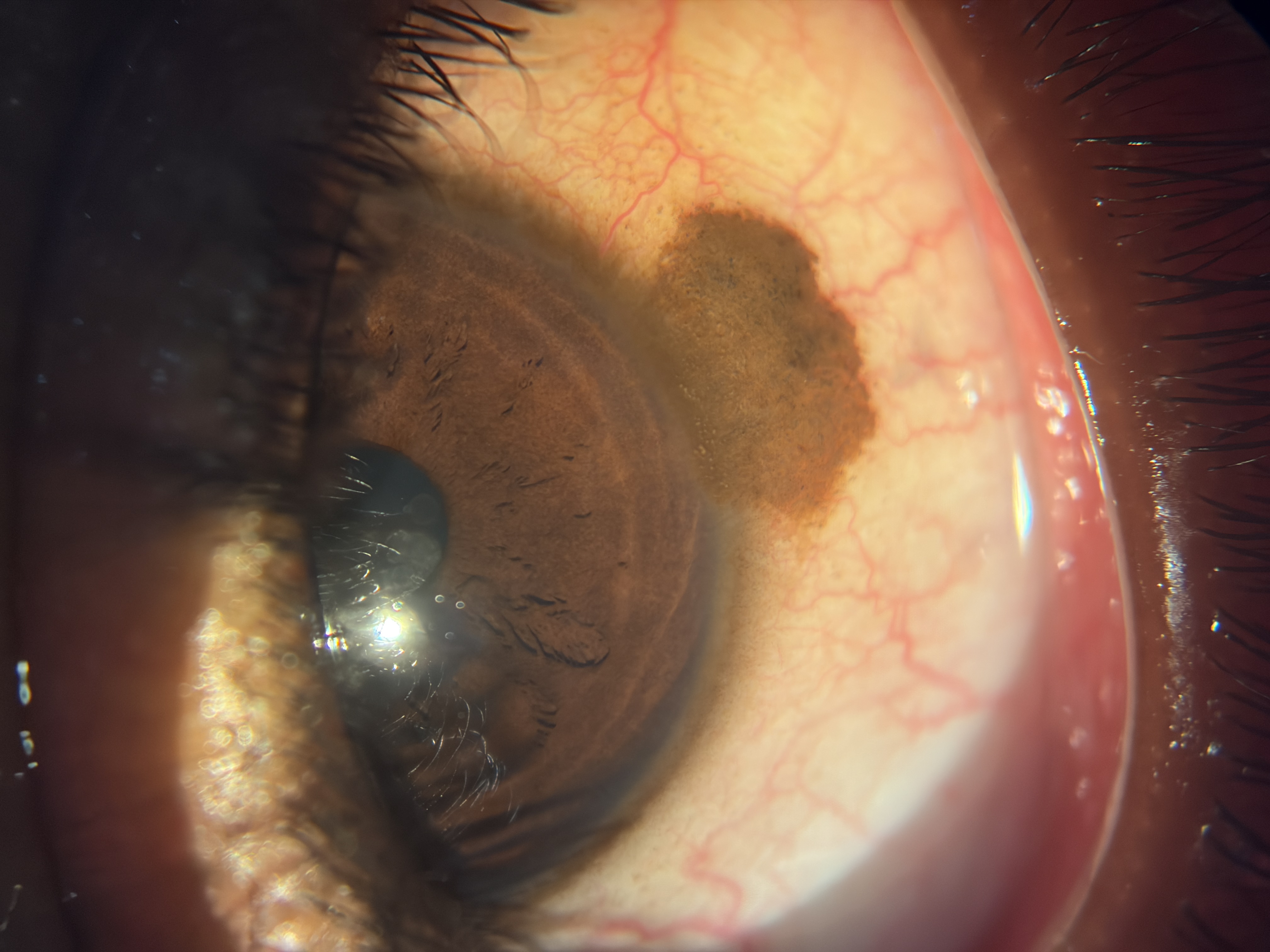 Conjunctival Naevus - Treatment Available at Shantanu Netralaya, Varanasi