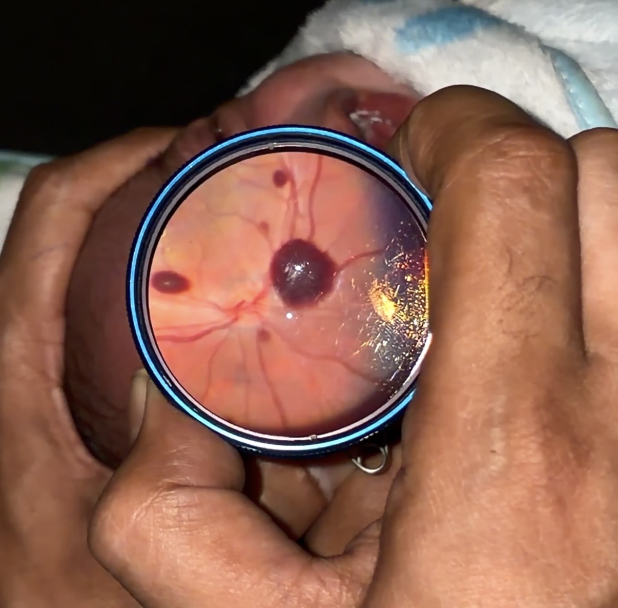 Neonatal Retina Hemorrhages - Retina Specialist In Varanasi