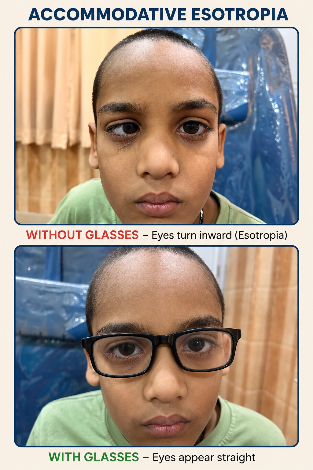 Accomodative esotropia (squint) treatment in varanasi at shantanu netralaya Dr Manisha Mishra 