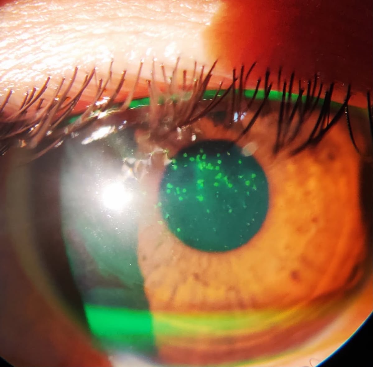 Slit lamp photo of fluorescein stain positive superficial punctate keratitis
