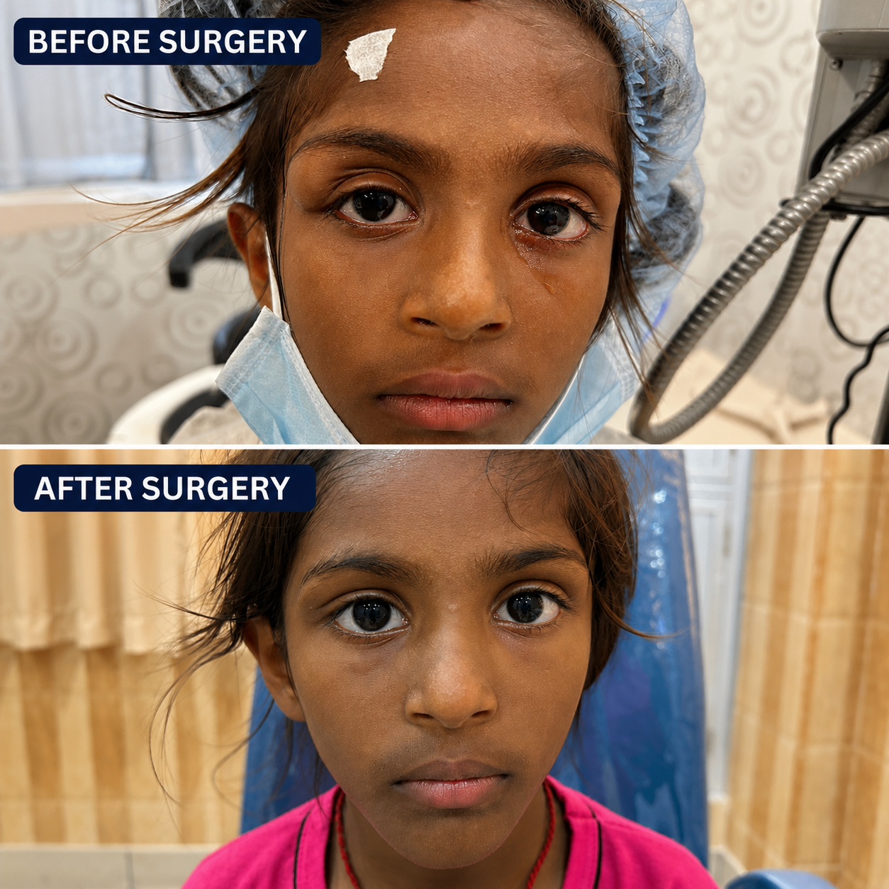 Orbital dermoid operated at Shantanu Netralaya Dr Manisha Mishra