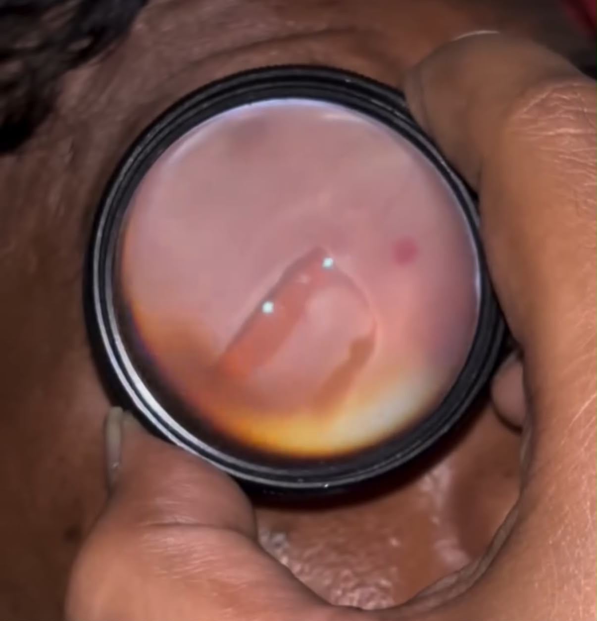 Fundus photo showing a large horse shoe tear
