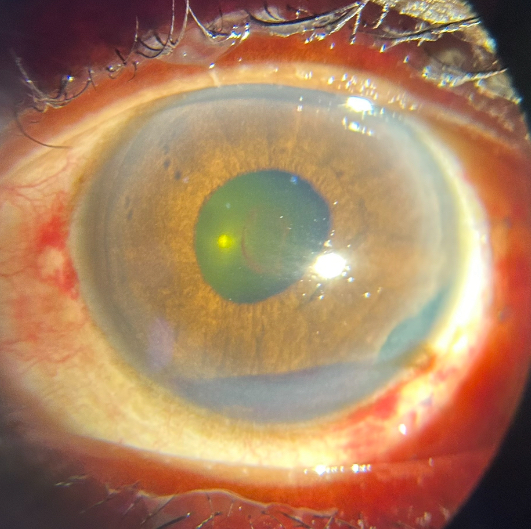 Ocular trauma treated at Shantanu Netralaya Dr Manisha Mishra 
