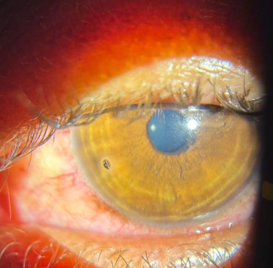 Corneal foreign body removal at Shantanu Netralya Dr Manisha Mishra 