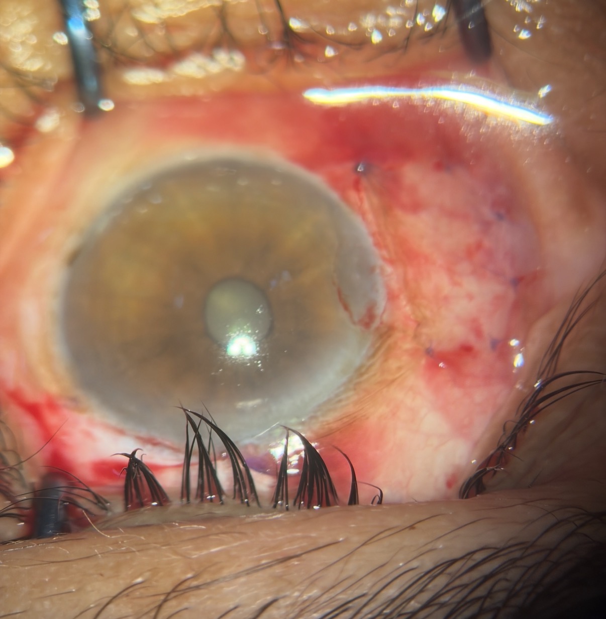 Best Pterygium Treatment in Varanasi