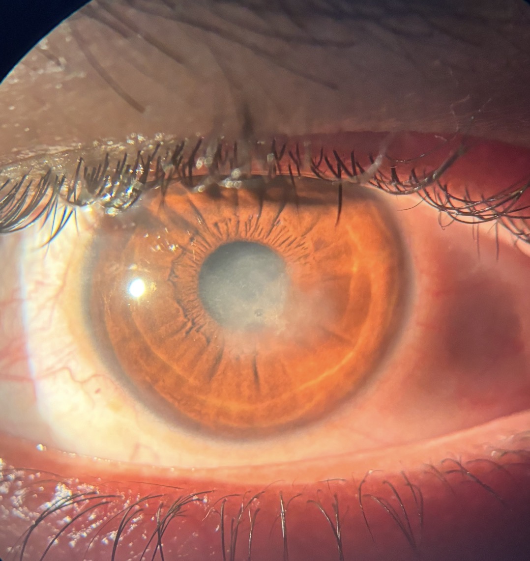 Corneal Endothelitis Treatment In Varanasi