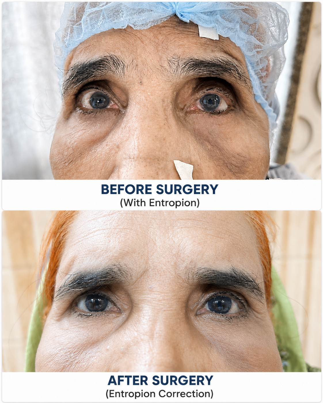 Entropion surgery done by Dr Manisha Mishra at Shantanu Netralaya 