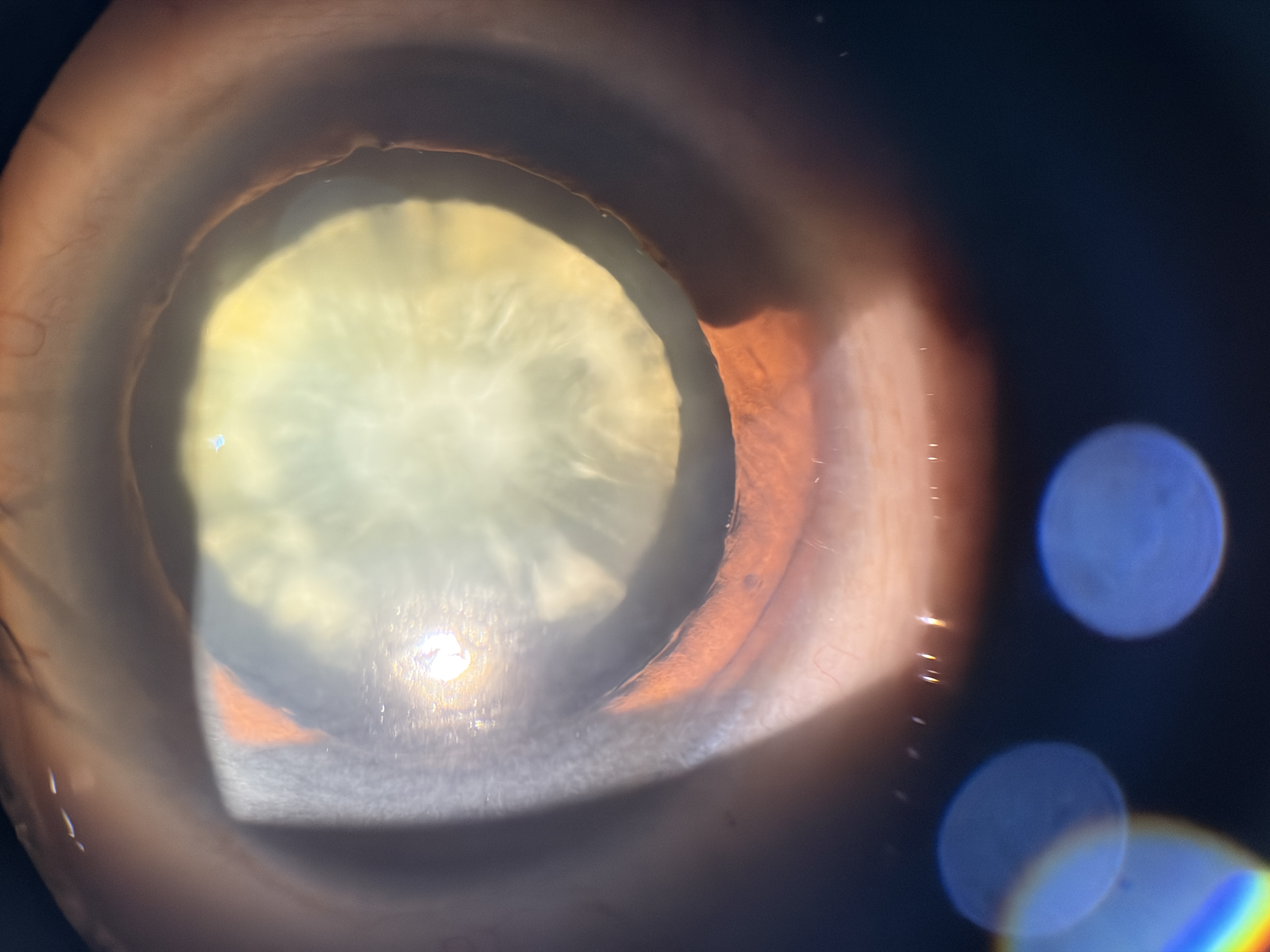 Zonular Cataract Surgery In Varanasi