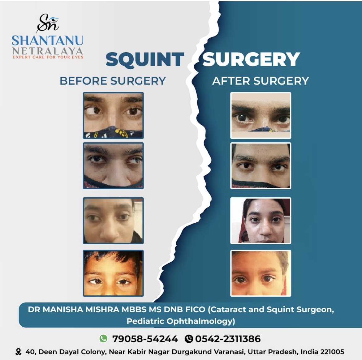 Squint surgery results at Shantanu Netralaya